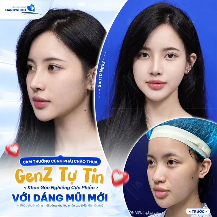 GenZ tự tin khoe góc nghiêng cực phẩm với dáng mũi mới sau thực hiện
