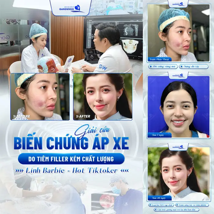 giai cuu bien chung ap xe do tiem filler kem chat luong