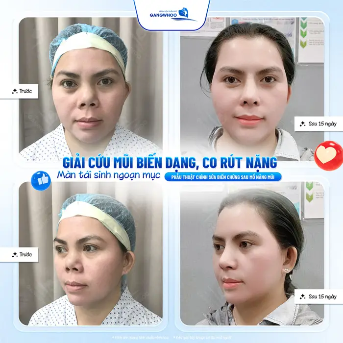 Nâng Mũi Bị Hỏng: Cách Nhận Biết, Nguyên Nhân, Cách Khắc Phục 1 Giải cứu mũi bỏng, mũi biến dạng và co rút nặng tái sinh ngoạn mục nhan sắc và diện mạo đầy tự tin và thu hút