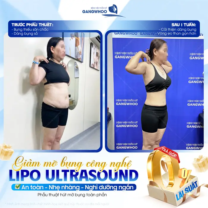 Giảm mỡ bụng công nghệ Lipo Ultrasound an toàn, nhẹ nhàng, nghỉ dưỡng ngắn với chi phí nhẹ nhàng 