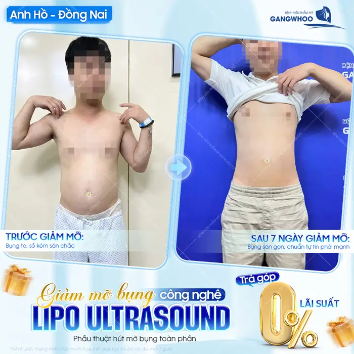 Giảm mỡ công nghệ Lipo Ultrasound bụng đẹp thon gọn sau 7 ngày vóc dáng đã thon thả hơn thấy rõ