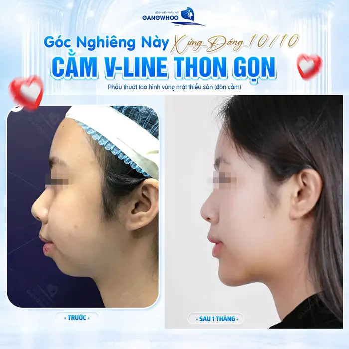 Độn Cằm Chi Phí Bao Nhiêu? Bảng Giá Độn Cằm Mới 2026 7 Cằm V Line đẹp thon gọn, diện mạo thêm cuốn hút, nhìn góc nghiêng này quá xứng đáng 10 điểm
