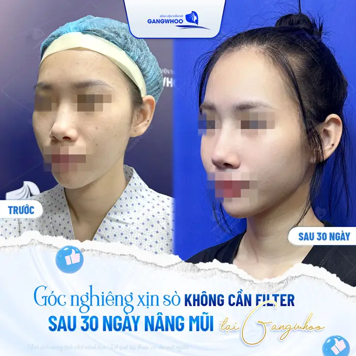 Góc nghiêng xịn xò không cần chỉnh filter sau 30 ngày nâng mũi tại Gangwhoo