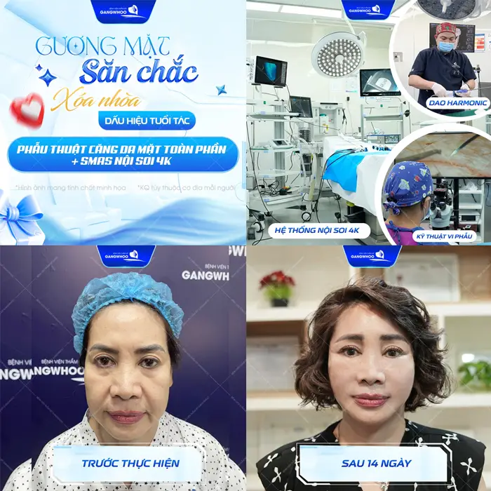 Căng Da Mặt Trả Góp - Làm Đẹp Trước Trả Tiền Sau Tại Gangwhoo 2 Gương mặt săn chắc xóa nhòa dấu hiệu tuổi tác sau 14 ngày thực hiện đã hoàn toàn khác biệt