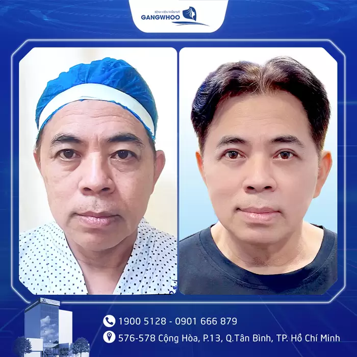 Cắt Mí Perfect Giải Pháp Cho Mắt 2 Mí Đẹp Hài Hòa Chuẩn Tự Nhiên 10 hinh anh cat mi gia 1