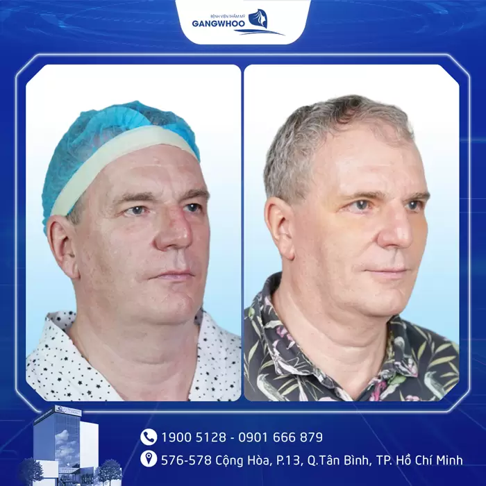 Cắt Mí Perfect Giải Pháp Cho Mắt 2 Mí Đẹp Hài Hòa Chuẩn Tự Nhiên 11 hinh anh cat mi gia 2