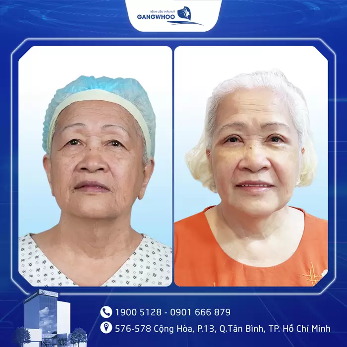 Cắt Mí Perfect Giải Pháp Cho Mắt 2 Mí Đẹp Hài Hòa Chuẩn Tự Nhiên 12 hinh anh cat mi gia 3