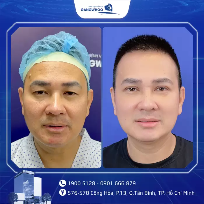 Cắt Mí Perfect Giải Pháp Cho Mắt 2 Mí Đẹp Hài Hòa Chuẩn Tự Nhiên 9 hinh anh cat mi gia 4