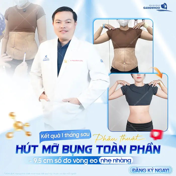 Kết quả 1 tháng sau phẫu thuật hút mỡ bụng toàn phần giảm gần 10 cm vòng eo nhẹ nhàng