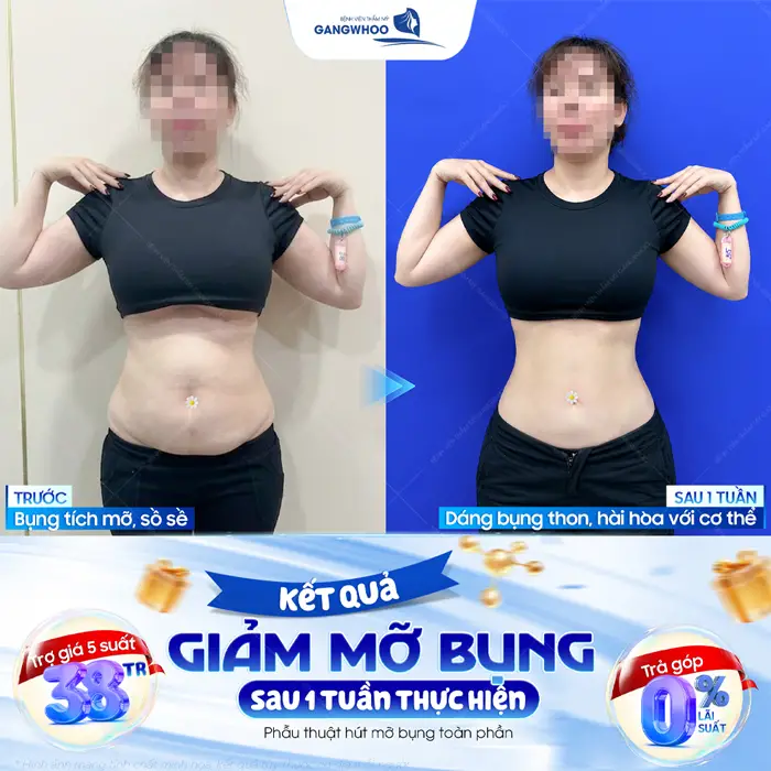 Kết quả giảm mỡ bụng sau 1 tuần thực hiện dáng bụng thon, hài hòa hơn với cơ thể
