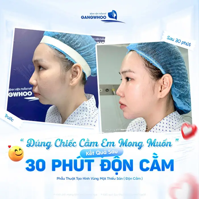 Kết quả sau 30 phút độn cằm tại bệnh viện thẩm mỹ Gangwhoo tự tin khoe cằm đẹp đúng như mong muốn