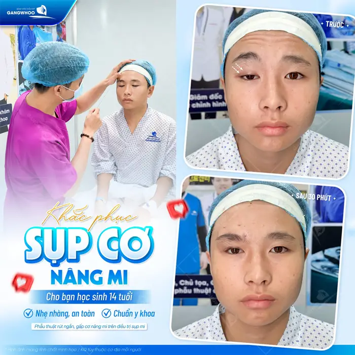 Phẫu Thuật Rút Ngắn, Gấp Cơ Nâng Mi Trên Điều Trị Sụp Mí Bẩm Sinh 2 Khắc phục sụp cơ nâng mi cho bạn học sinh 14 tuổi nhẹ nhàng, chuẩn y khoa