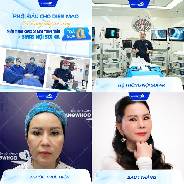 Khởi đầu cho diện mạo trẻ trung đầy sức sống sau phẫu thuật căng da mặt toàn phần Smas nội soi 4K