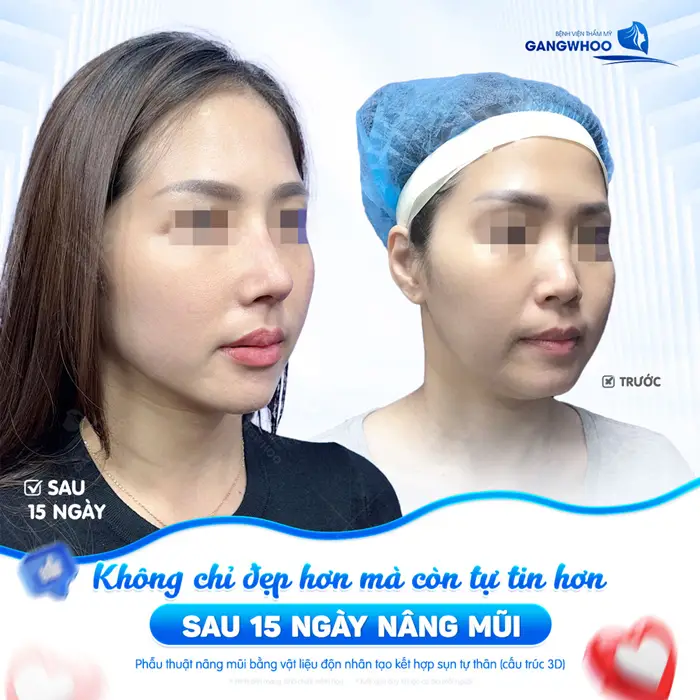 Nâng Mũi Bọc Sụn Thái Dương Là Gì? Có Ưu Điểm Gì? 1 Không chỉ cần đẹp hơn mà còn tự tin hơn sau 15 ngày nâng mũi diện mạo và nhan sắc thăng hạng hơn thấy rõ