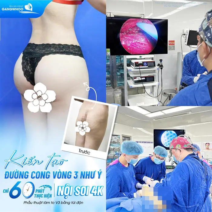 Kiến tạo đường cong vòng 3 như ý với công nghệ nâng mông nội soi hiện đại tự tin tôn đường cong đẹp xuất sắc