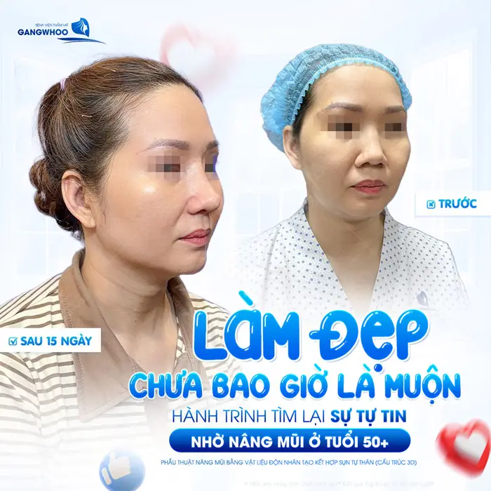 Nâng Mũi Về Già Có Biến Chứng Không? 6 Hậu Quả 6 Làm đẹp chưa bao giờ là muộn hành trình tìm lại sự tự tin nhờ nâng mũi ở tuổi 50