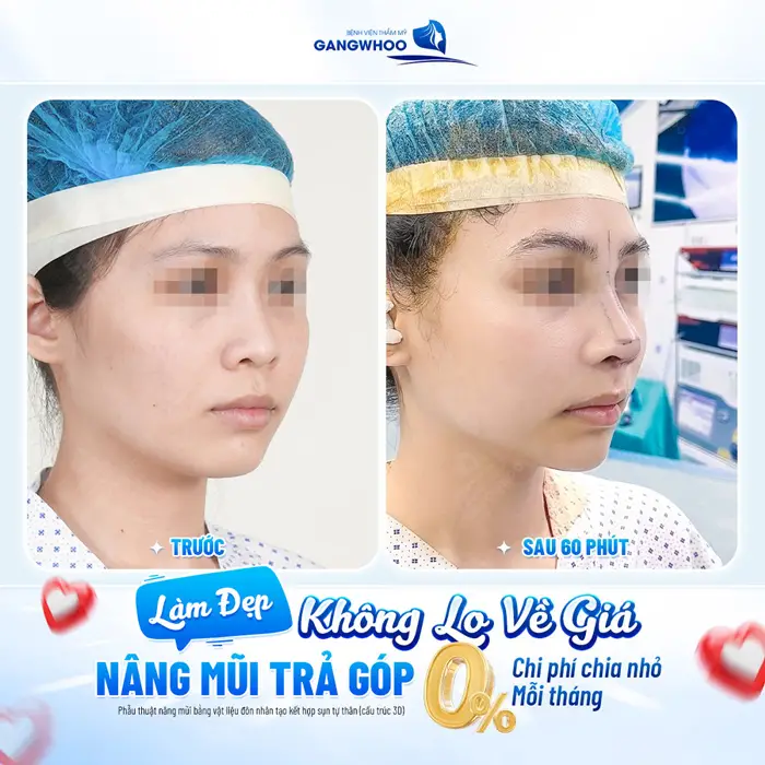 Dịch vụ thẩm mỹ trả góp có tốt không? 1 Làm đẹp không lo về giá khách hàng nâng mũi trả góp không lo về chi phí