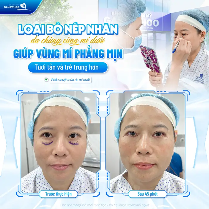 Loại bỏ nếp nhăn da chùng mí dưới giúp vùng mí phẳng mịn tươi tắn và trẻ trung hơn