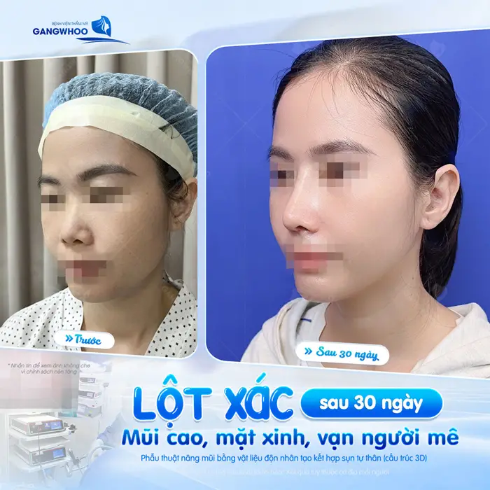 Lột xác sau 30 ngày nâng mũi tự tin hơn với gương mặt xinh đẹp, hài hòa 