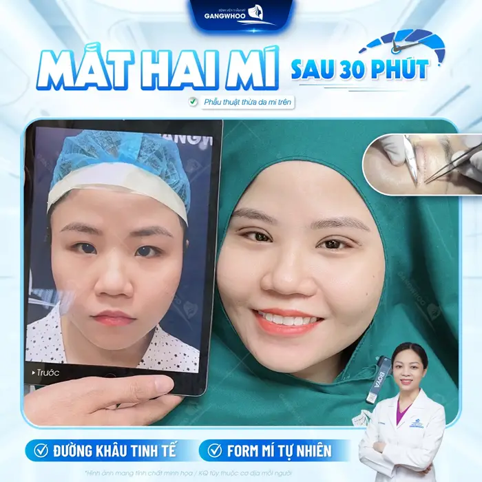Mắt 2 mí đẹp chẩun tự nhiên với đường khâu tinh tế sau 30 phút thực hiện đã hoàn toàn khác biệt