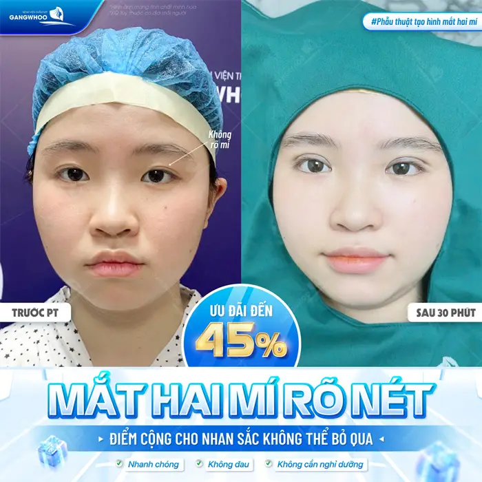 Mắt hai mí rõ nét điểm cộng cho nhan sắc không thể bỏ qua