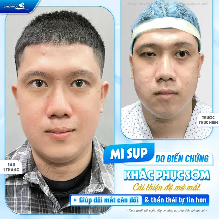 Mí sụp do biến chứng khắc phục sớm cải thiện độ mở của mắt giúp đôi mắt cân đối và thần thái tự tin hơn 