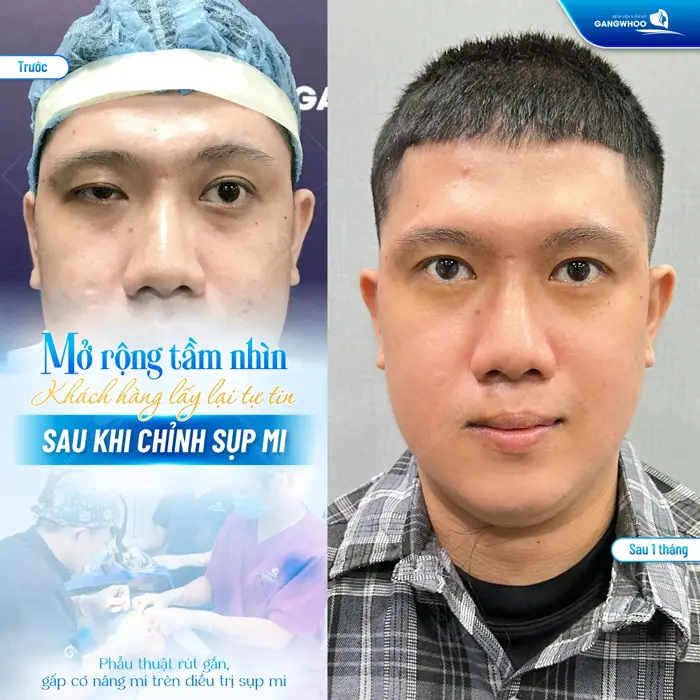 Phẫu thuật rút gắn, gấp cơ nâng mĩ trên điều trị sụp mi cải thiện tầm nhìn khôi phục chức năng mắt hiệu quả