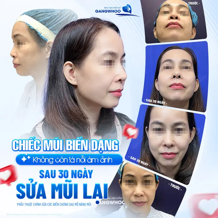 Chiếc mũi biến dạng không còn là nỗi ám ảnh sau 30 ngày sửa mũi lại tại BVTM Gangwhoo