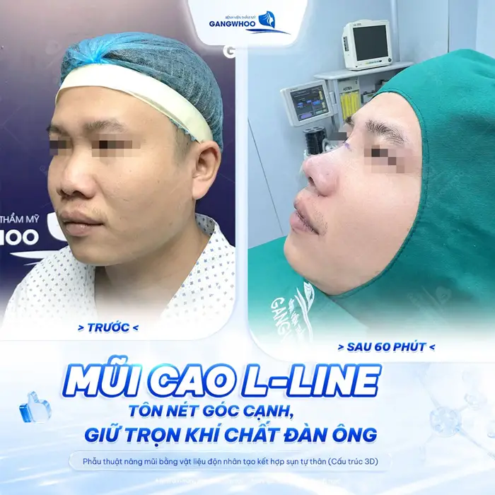 Mũi cao L Line tôn nét góc cạnh giữ trọn khí chất đàn ông