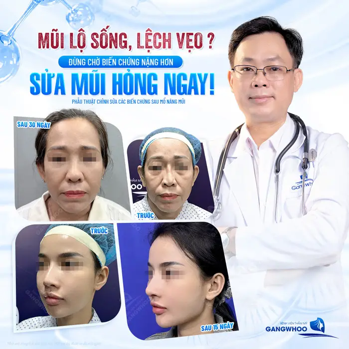 Mũi lộ sống, lệch vẹo sửa mũi hỏng ngày để tránh biến chứng nguy hiểm về sau