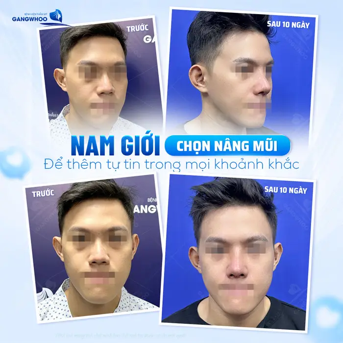 Nam giới chọn phẫu thuật nâng mũi để tự tin hơn trong mọi khoảnh khắc