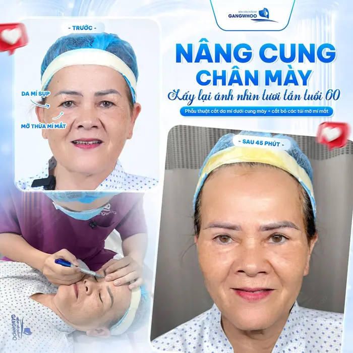 Nâng cung chân mày lấy lại ánh nhìn tươi tắn ở tuổi 60 gương mặt thêm trẻ đẹp và đầy rạng rỡ