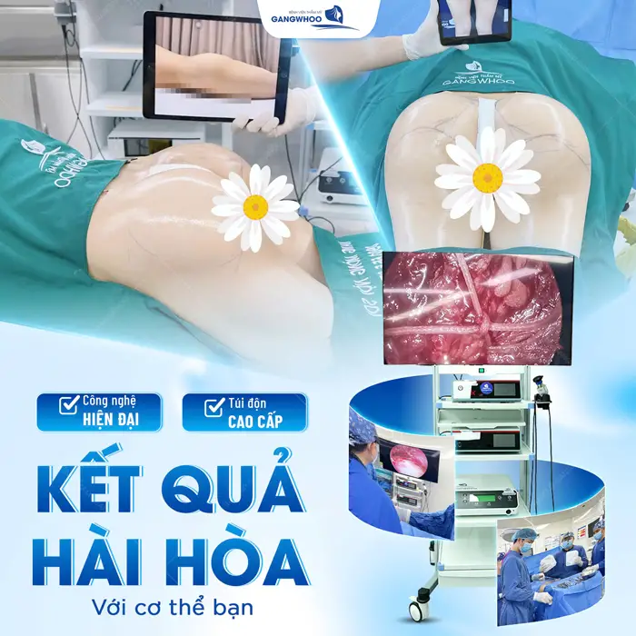 Kết quả hài hòa với cơ thể chỉ 1 lần thực hiện nâng cấp vòng 3 ứng dụng công nghệ nội soi hiện đại 