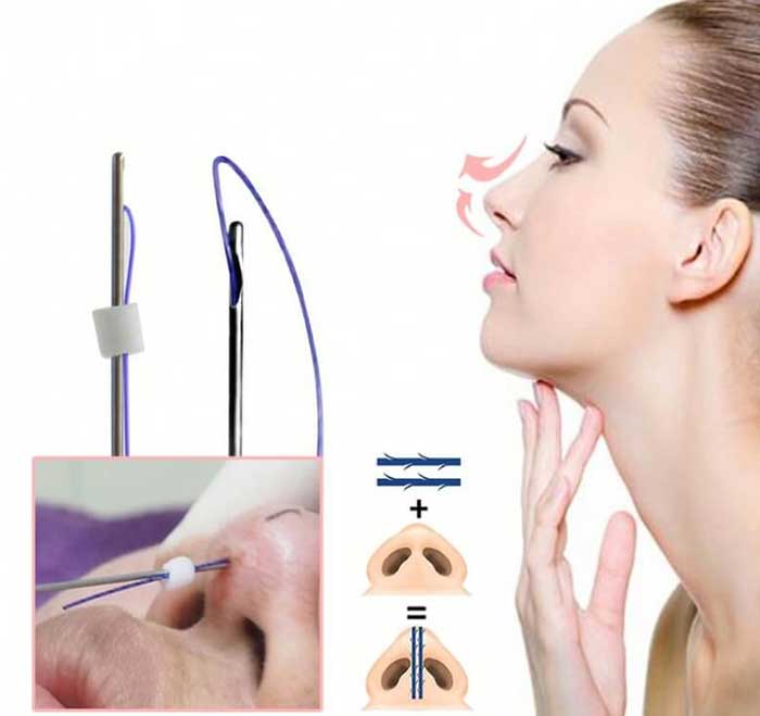 Nose thread lift comes with many risks