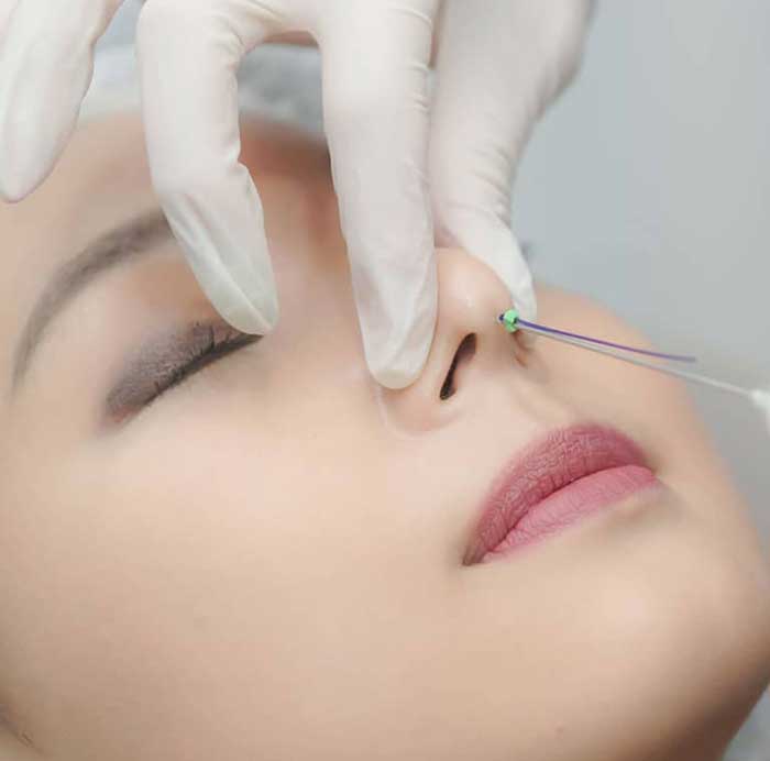 Image of nose thread lift