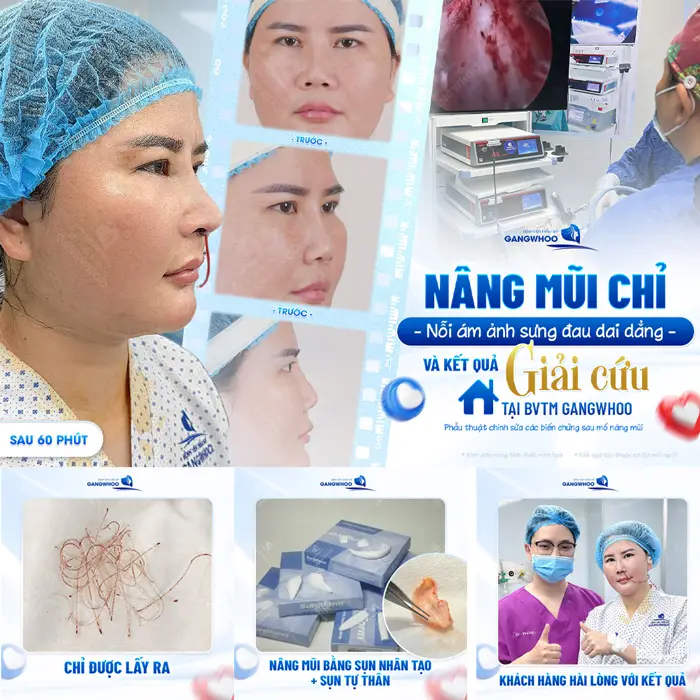Nâng mũi bằng chỉ nỗi ám ảnh khi thực hiện sai kỹ thuật, khách hàng tìm đến Gangwhoo khắc phục 