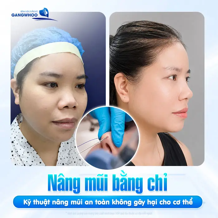 Nâng Mũi Bằng Chỉ Có Tốt Không? [Bác Sĩ Giải Đáp]