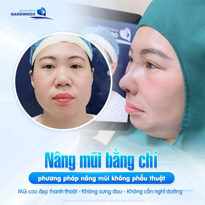 Nâng Mũi Bằng Chỉ Có Tốt Không? [Bác Sĩ Giải Đáp]