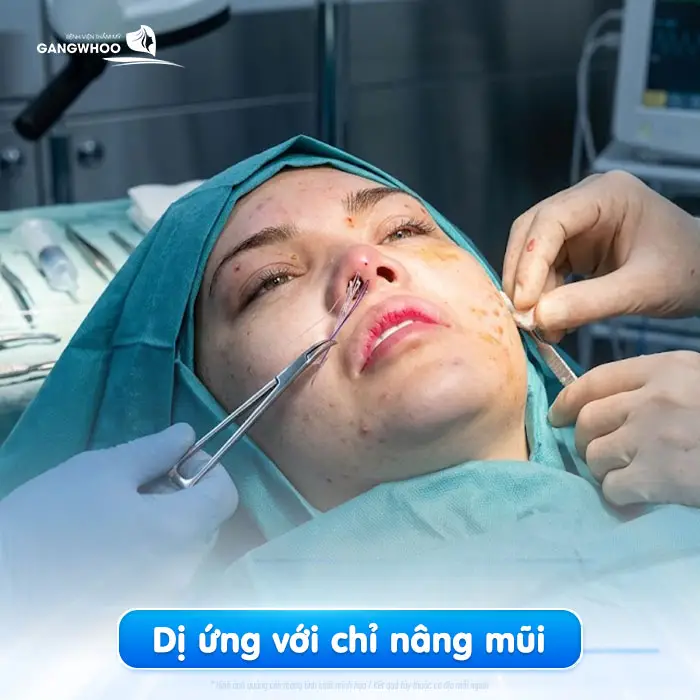 Nâng Mũi Bằng Chỉ Có Tốt Không? [Bác Sĩ Giải Đáp]