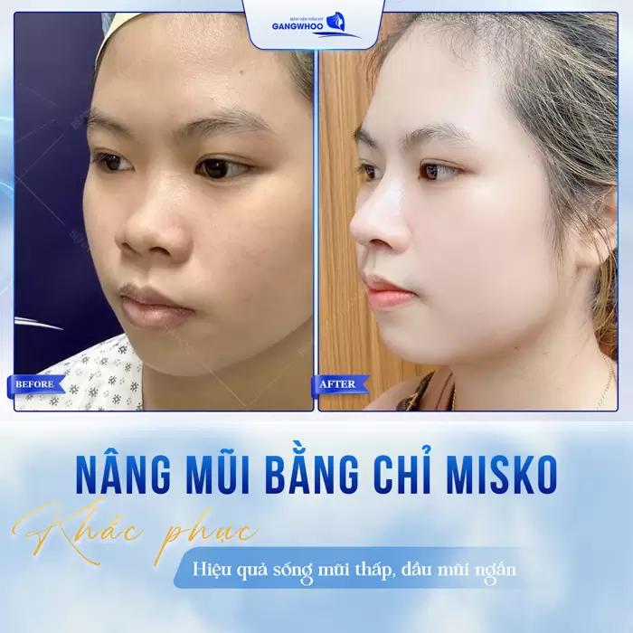 Nâng Mũi Bằng Chỉ Misko Nano Là Gì? Giá Bao Nhiêu? 1 nang mui bang chi misko hieu qua