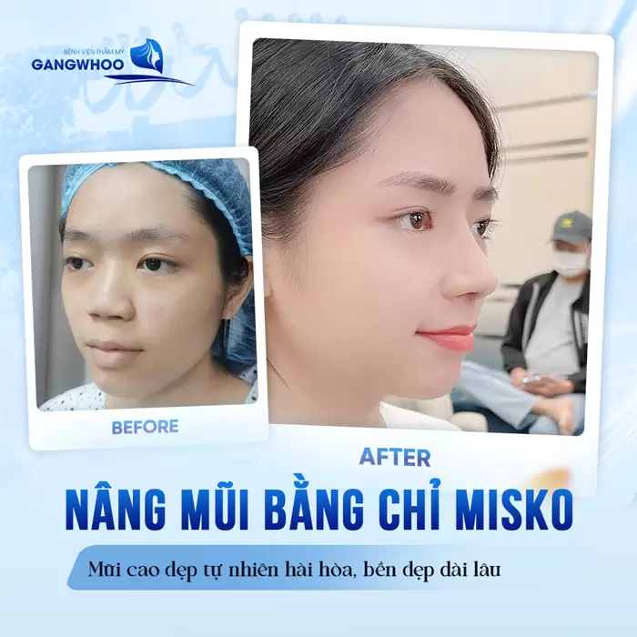 Nâng Mũi Bằng Chỉ Misko Nano Là Gì? Giá Bao Nhiêu? 3 nang mui bang chi misko mui cao dep tu nhien hai hoa