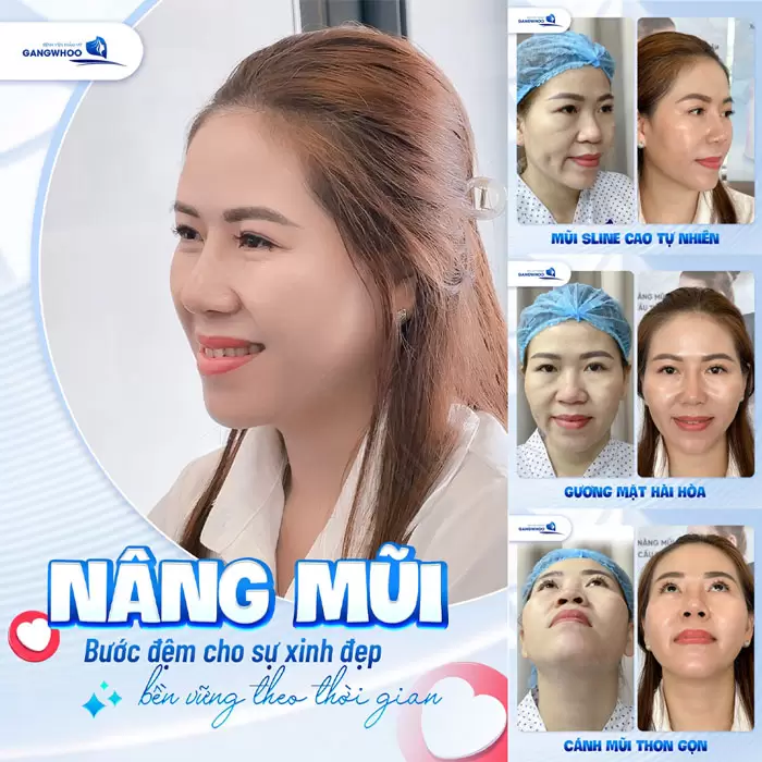 Nâng mũi bước bước đệm cho sự xinh đẹp bền vững theo không lo cong vẹo