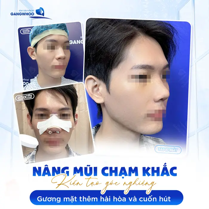 Nâng mũi chạm khắc kiến tạo góc nghiêng đẹp xuất sắc mặt thêm hài hòa và cuốn hút 