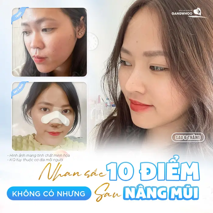 Nhan sắc 10 điểm không có nhưng sau nâng mũi ai gặp cũng khen xinh 