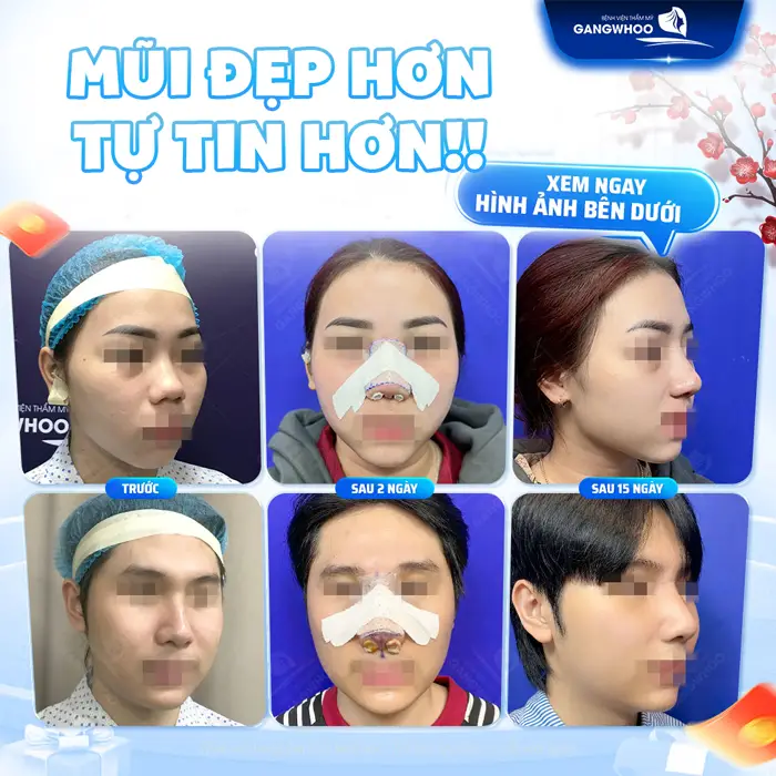 Chăm sóc đúng mũi nhanh đẹp nhanh lành thương chỉ sau 15 ngày đã ổn định thấy rõ