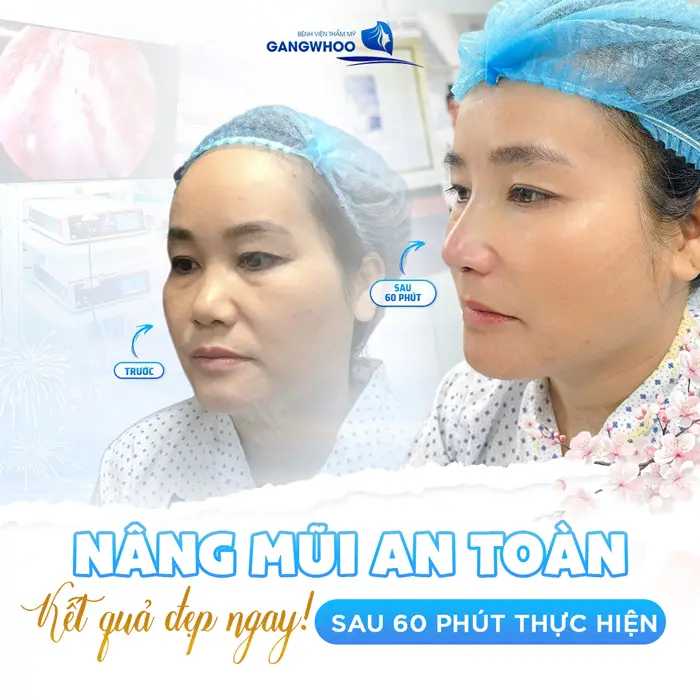 Nâng mũi an toàn kết quả đẹp ngay sau 60 phút thực hiện 