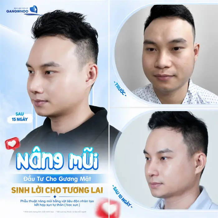 Nâng mũi là giải pháp đầu tư cho gương mặt thêm cuốn hút và rạng rỡ hơn trong tương lai