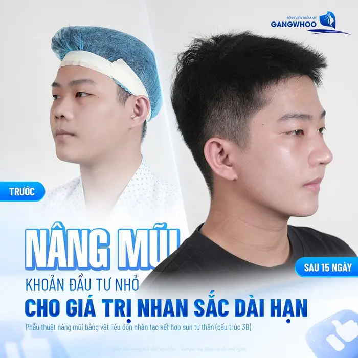 Nâng Mũi Nam Giá Bao Nhiêu Tiền? Giá Mới Năm 2026