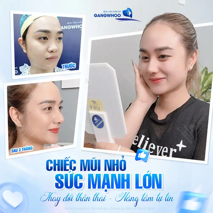 Nâng Mũi Không Phẫu Thuật Có An Toàn Không? Bác Sĩ Giải Đáp