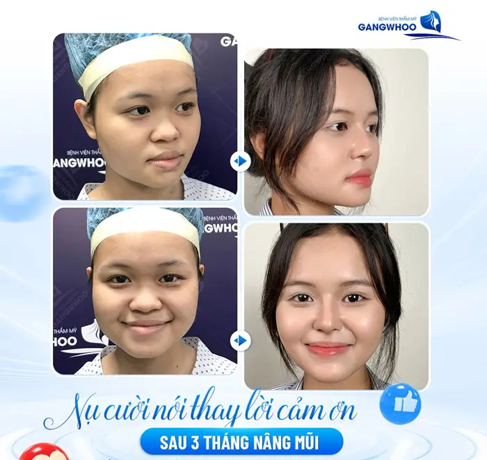 Nâng Mũi Không Phẫu Thuật Có An Toàn Không? Bác Sĩ Giải Đáp